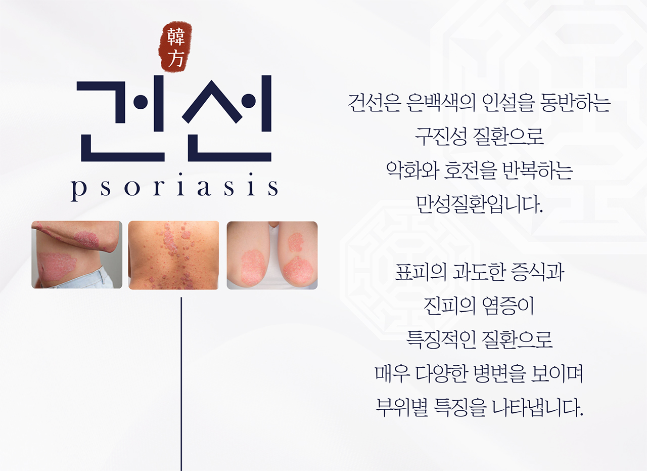 치료프로그램