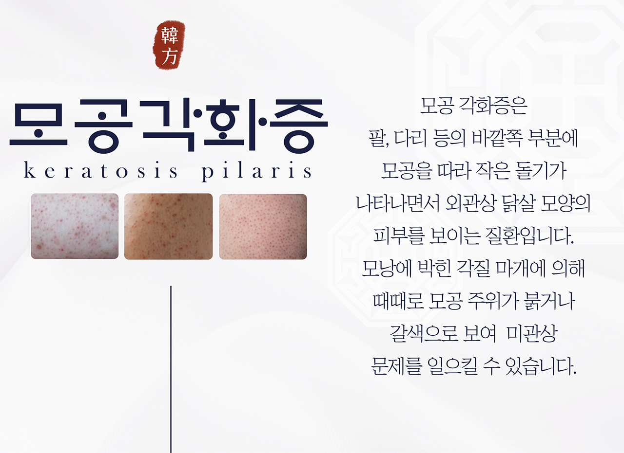 치료프로그램